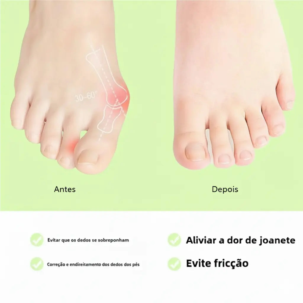 Corretor de Joanete em Silicone – Alinhador de Dedo